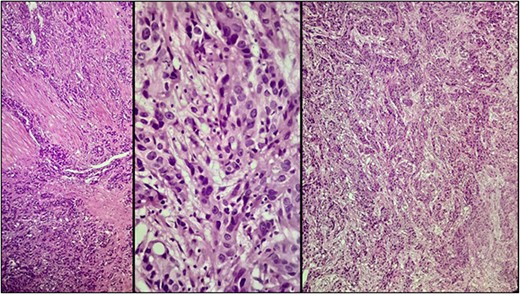 Microscopic examination showing neoplastic cells arranged in irregular nests invading the lamina propria and muscularis propria. Tumors cells showing nuclear pleomorphism, hyperchromasia, high N/C ratio with frequent mitotic figures.