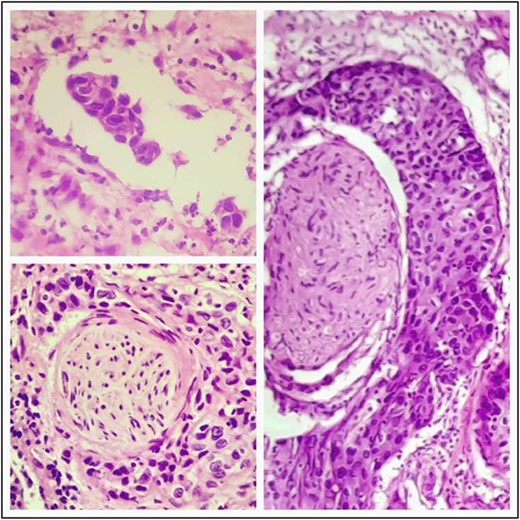 Lymphovascular and neural invasion is seen.