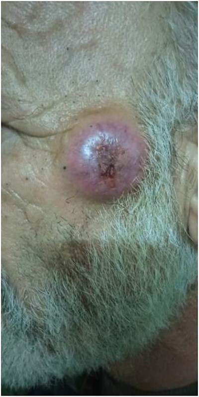 Metastatic at left cheek.