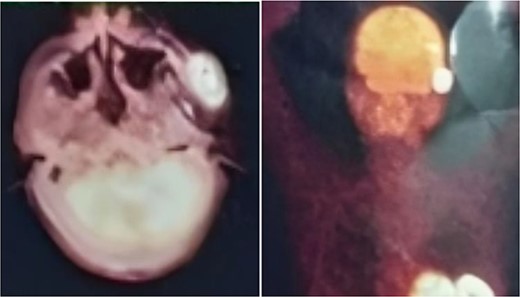 PET-CT demonstrating an unclear, heterogeneous mass that leachates into the skin and adipose tissue underneath it and the left masticatory muscle measuring 40 × 20 mm showing pathological metabolic activity.