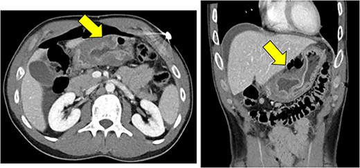 Significant mural thickening of gastric antrum with pneumoperitoneum along the anterior, superior wall, and free fluid around the liver, consistent with a perforated gastric ulcer.