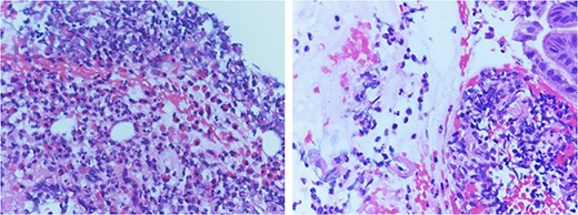 Pathology review demonstrated increased eosinophil infiltration (>20 eosinophils per 40 x High Power Field) in submucosa with fragments of gastric mucosa, consistent with eosinophilic gastritis.