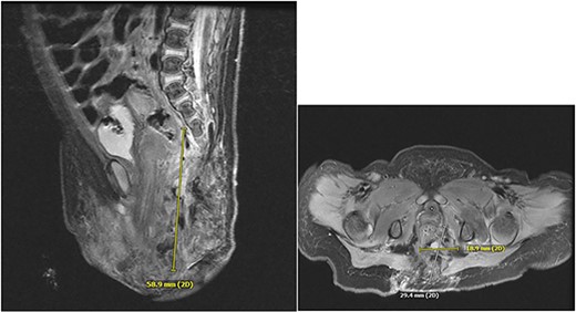 Dysmorphic sacrum with rightward curvature. There is an intradural terminal lipoma present along the left aspect of the lower cord, extending from L3-L4 to the caudal thecal sac. Presumed extensive vascular malformation.