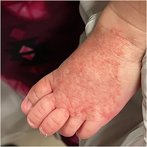 IH of dorsum of left foot.