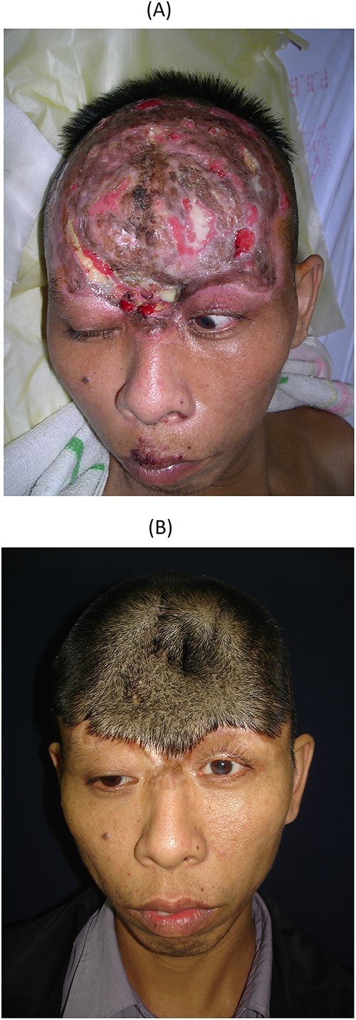 The first surgery, the patient with complex scalp injuries after a high-voltage electrical burn; (A) preoperative injuries; (B) postoperative with bi-parietal flap to cover the defect.