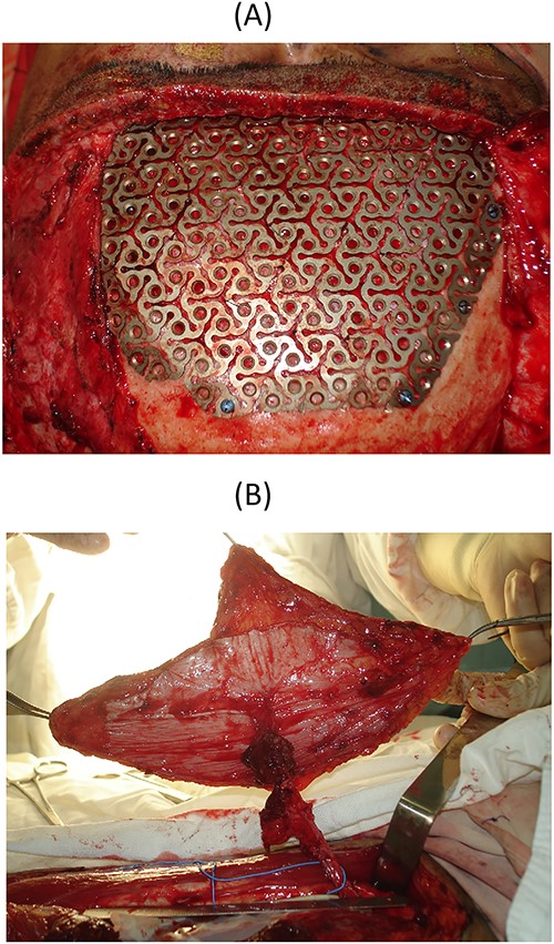 In the second surgery; (A) cranioplasty with titan mesh; (B) the ALT flap was harvested, measuring 12 × 18 cm;