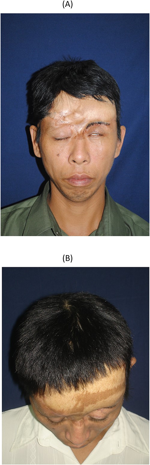 The final result of the 7-year follow-up; (A) front view; (B) parietal view.