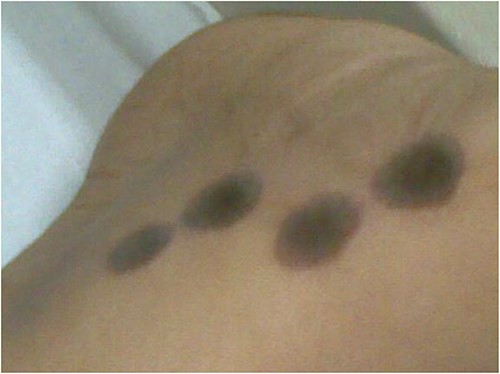 Image showing skin burns.