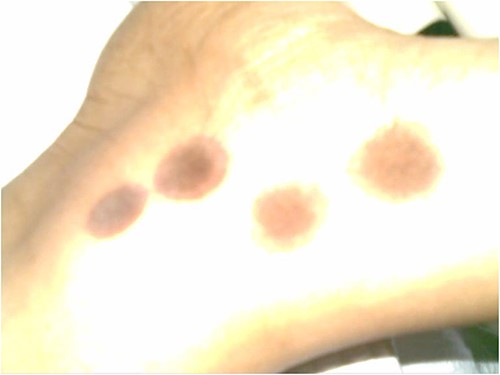 Image showing healing of burn.