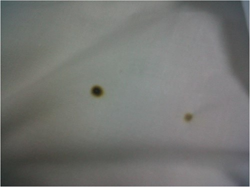 Burn on outside drape.