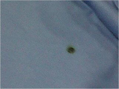 Burn on inside drape.