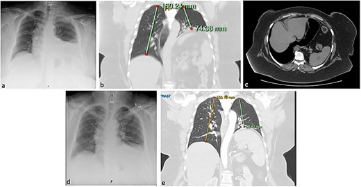 Chest X-ray (CXR; a) and computed tomography (CT) of the chest and abdomen in coronal (b) and axial (c) planes, showing eventration of the left hemidiaphragm and angulation of the stomach. Resolution of eventration on CXR at one day post-plication on CXR (d) and on CT at six months post-plication (e).
