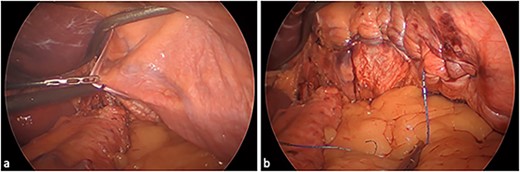 Eventrated left hemidiaphragm: (a) unrepaired and (b) post medial-to-lateral plication.