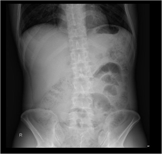 Abdominal X-ray with subtle evidence of pneumoperitoneum.