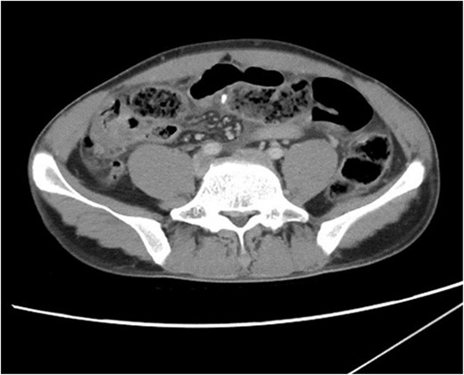 CT scan of abdomen and pelvis. A radiopaque object is seen extruding from a thickened small bowel loop with associated free peritoneal fluid, concerning for foreign body perforation of small bowel.