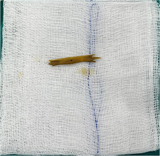 Fractured piece of bone following extraction.