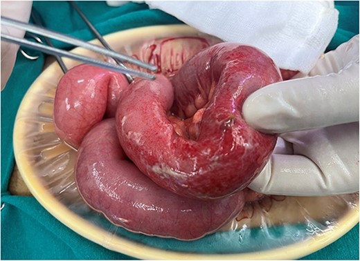 Site of perforation in mid jejunum.
