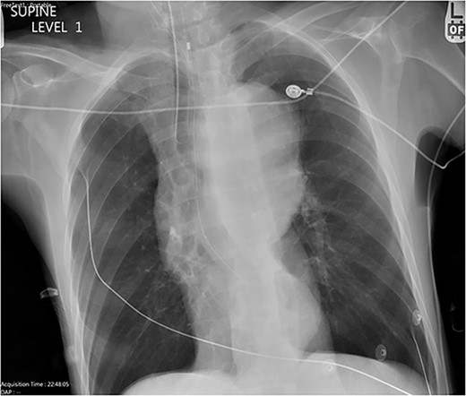 Chest X-ray with patient supine showing an impressive dilated thoracic aorta consistent with a large thoracic aneurysm.