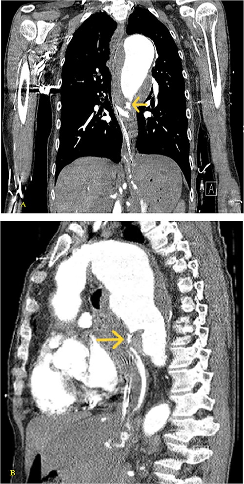 (A) Coronal and (B) sagittal views of the arterial phase CT chest with IV contrast performed during the initial trauma evaluation show aneurysmal dilation of the thoracic aorta with contrast extravasation into the esophagus and stomach.