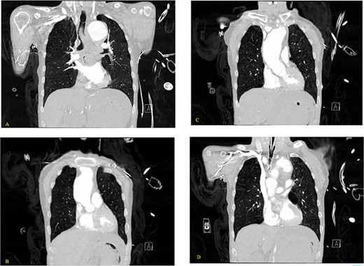 (A–D) Coronal CT chest with contrast reveal the descending aortic aneurysm of at least 6.5-cm diameter. Deep ulceration in the descending aorta at approximately the level of the pulmonary artery bifurcation. The ulceration has eroded into the esophagus. Extravasation of contrast is observed from the ulceration into the esophagus.