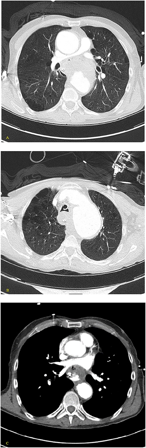 (A, B) Axial nonenhanced CT chest with contrast and (C) axial enhanced CT chest with contrast reveal an extensive clot around the aorta and around the esophagus with some mass effect on the pulmonary arteries and the LA. Clot fills the aorta.