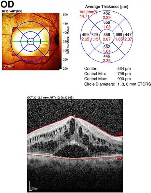 Optical Coherence Tomography (OCT) of the right eye showed central involvement macular edema with intra-retinal and sub-retinal fluid accumulation.