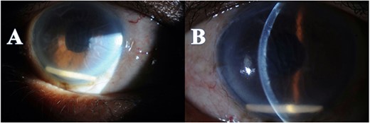 Anterior segment photo showed the Ozurdex implant migration to the anterior chamber with secondary corneal edema (A), with Descemet folds (B).