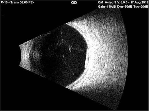 Ultrasound b-scan exam of the right eye showed a reflective small tube inferior and posterior to the equator on the 1st day of admission with only bed rest in the supine position and using cycloplegic drops.