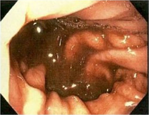 Initial gastroscopy – old, dark blood in stomach.
