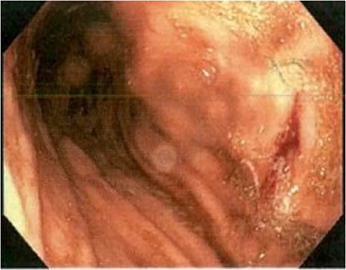 Initial gastroscopy - linear gastric ulcer on greater curvature of stomach.