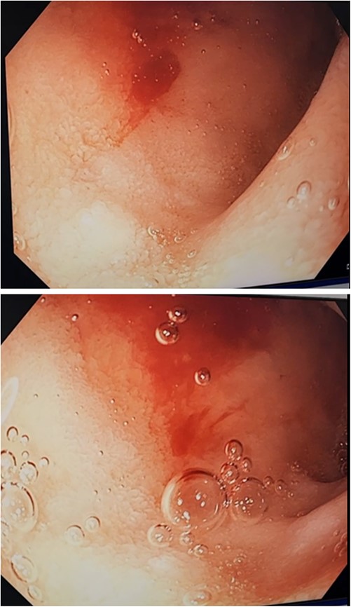 Second gastroscopy – active arterial bleeding at D1/D2 from small mucosal defect without surrounding ulceration.