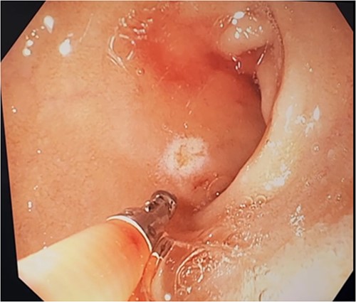 Second gastroscopy – successful haemostasis of actively bleeding duodenal DL with thermocoagulation and adrenaline injection.