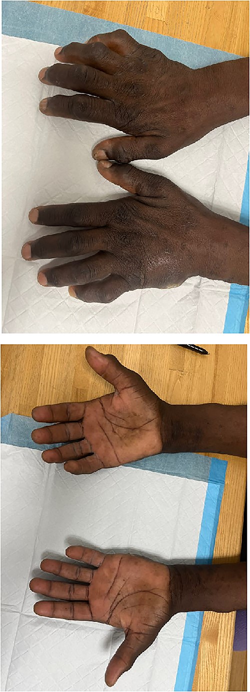 Images depicting patient hands after being instructed to lay flat on a level surface. Dorsal (A) and volar (B) aspects of the bilateral hands demonstrating marked joint enlargement and prominent flexion of bilateral MCP joints (right > left).