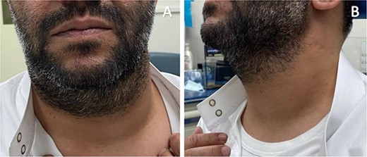 The reported patient with left neck swelling. (A) Anterior view. (B) Lateral view.