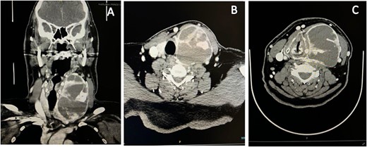 Neck CT scan revealed diffusely enlarged complex cystic and solid thyroid nodule compressing the trachea causing shift to the right side. (A) Coronal view. (B, C) Axial view.
