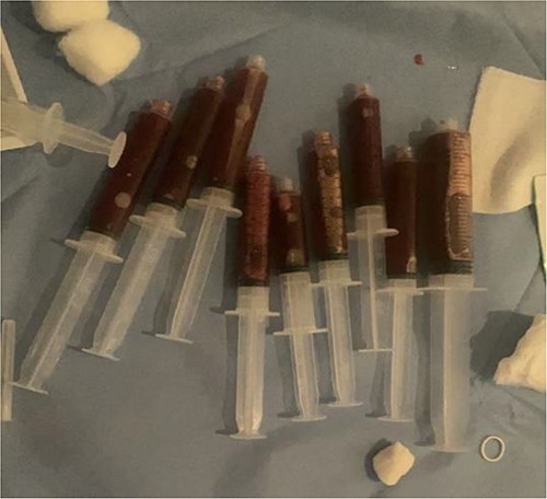 Ultrasound-guided aspiration by interventional radiology which showed a 110 ml aspirate of dark blood.