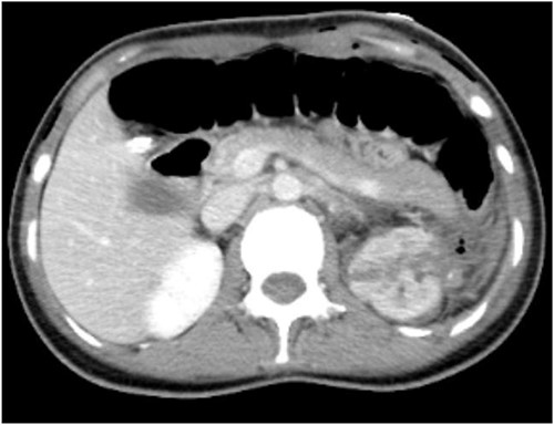 CT shows uneven density and disordered structure in the upper pole of the left kidney, with turbidity and increased density in the surrounding fat spaces.