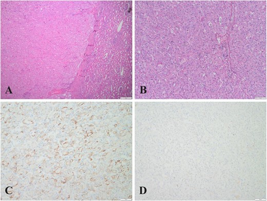 (A) (HE,×4). Eosinophilic cell tumor with well-defined tumor boundaries and acidophilic tumor cells in solid tubular, nested, and microcystic arrangements; (B) (HE,×10). Eosinophilic cell tumor, homogeneous eosinophilic or eosinophilic granular cytoplasm with no vacuoles in the cytoplasm, round to oval nuclei with some perinuclear halos and sparse binuclei with slender perinuclear vacuoles; (C&D) (×10). Immunohistochemistry showed tumor cells positive for CK7 but negative for CD117.