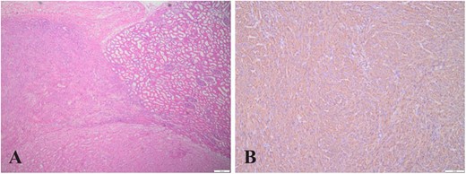 (A) (HE,×4). LOT, AML, and normal kidney tissue boundaries, where region a is AML, region b is normal kidney tissue, and region c is LOT; (B) (×10). Immunohistochemistry showing AML cells positive for SMA.