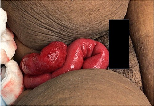 Evisceration of small bowel from vagina in a 35-year-old woman on initial presentation to the emergency room.