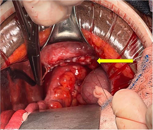 Intraoperative view of vaginal cuff repair after reduction of small bowel contents and resection of necrotic omentum. The vaginal cuff is indicated by the yellow arrow.