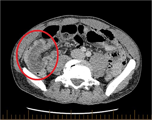 Axial CT of the abdomen and pelvis with portal venous contrast. Long segment of ileocolic intussusception shown (red circle).