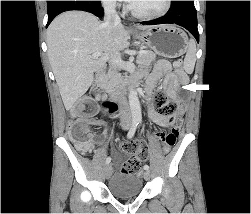 Coronal CT for abdomen and pelvis with portal venous contrast. Jejunal intussusception in left upper quadrant (white arrow).
