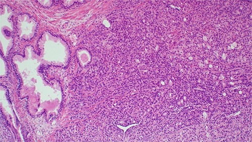 Histopathology image showing invasive prostatic adenocarcinoma, hematoxylin and eosin staining (H&E) staining 100× original magnification.