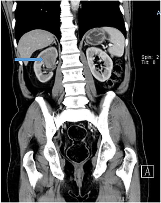 Abdomino-pelvis CT scan demonstrating a well-defined tumor mass at the supero-posterior right kidney pole that measures 3.6 × 4.1 × 4.9 cm.