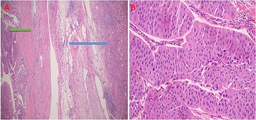 Photomicroscopy showing high grade renal urothelial carcinoma, and normal renal parenchyama; H&E staining 2 x original magnification (A); intermediate magnification of urothelial carcinoma displaying neoplastic cells in with high nuclear features in nests or papillary structures, H&E staining 10× original magnification (B).