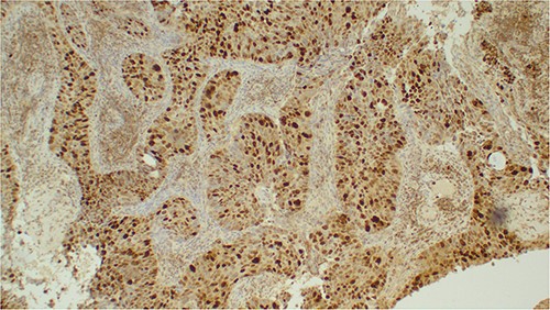 Photomicroscopic images of the urothelial carcinoma of the kidney demonstrating strong immunopositivity with CK20 immunohistochemistry; IHC 100× original magnification.