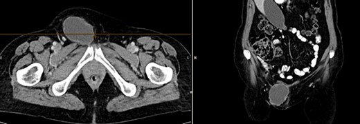 CT of the abdomen from 25 February 2022: oval encapsulated structure in the right groin area, most likely soft tissue hematoma, no active bleeding, DD enlarged lymph node.