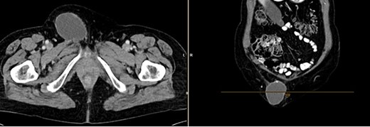 CT of the abdomen from 1 August 2022: size-progressive formation within the right inguinal hernia compared with the previous examination from 25 February 2022; no indication of tumor recurrence or metastasis-suspect lesions intra-abdominally, post-hysterectomy.
