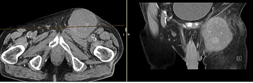 Finding from CT of the abdomen: highly suspicious malignant mass in the left groin area, with nearby satellite lesions, DD lymph nodes.